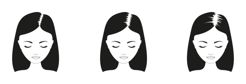 Quand commence l'alopécie androgénétique chez les femmes? Quand commence l'alopécie androgénétique chez les femmes?