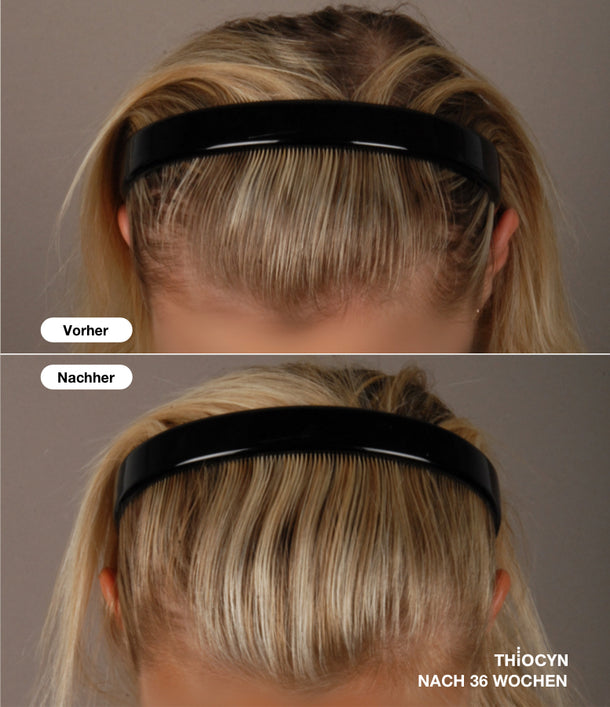 Vorher-Nachher-Vergleichsbild einer blonden Frau, nach der 36-wöchigen Anwendung des Thiocyn Haarserums Frauen. Vorher-Nachher-Vergleichsbild einer blonden Frau, nach der 36-wöchigen Anwendung des Thiocyn Haarserums Frauen.