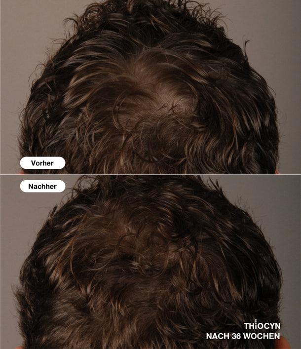 Vorher-Nachher-Vergleichsbild eines braunhaarigen Mannes, nach der 36-wöchigen Anwendung des Thiocyn Haarserums Männer. Vorher-Nachher-Vergleichsbild eines braunhaarigen Mannes, nach der 36-wöchigen Anwendung des Thiocyn Haarserums Männer.