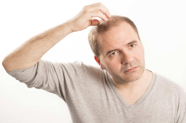 Androgenetic alopecia 