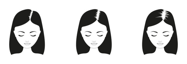 Quando inizia l'alopecia androgenetica nelle donne? 