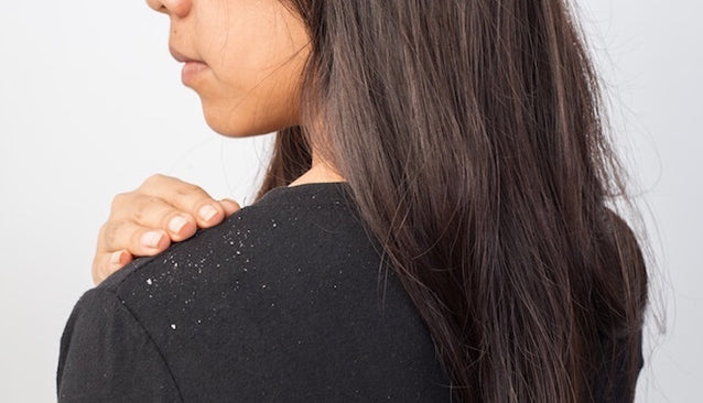 Hair loss by dandruff?