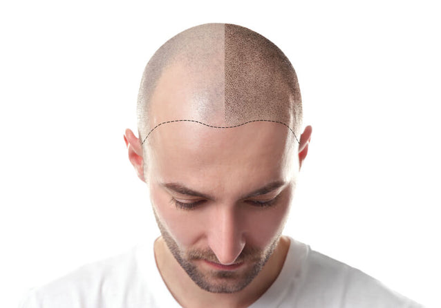 Hair loss after hair transplantation