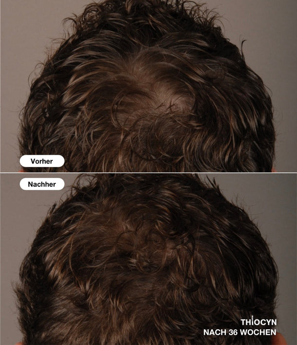 Vorher-Nachher-Vergleichsbild eines braunhaarigen Mannes, nach der 36-wöchigen Anwendung des Thiocyn Haarserums Männer.